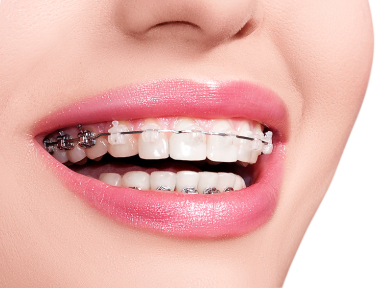 Tips to keep your teeth sparkly and white even with braces in Lakeland, FL