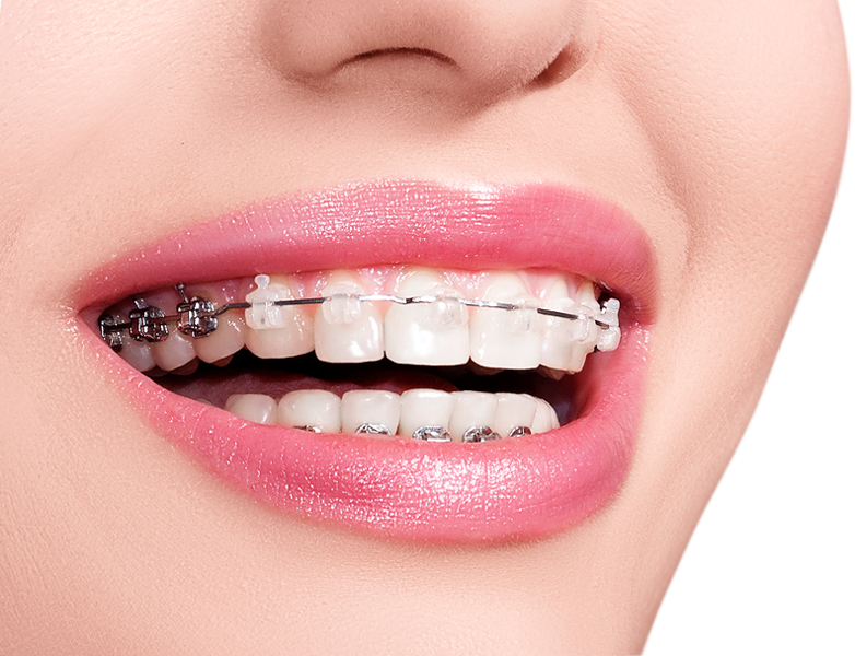 Tips to keep your teeth sparkly and white even with braces in Lakeland, FL